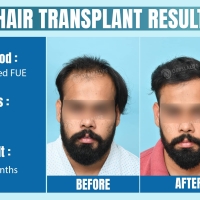 Hair Transplant in Delhi | Dr. Gaurav Garg - Top Hair Transplant Surgeon